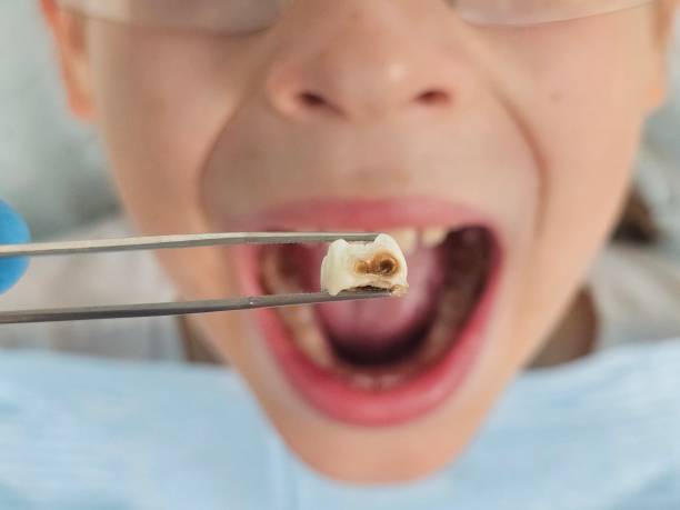 Best Emergency Wisdom Teeth Removal in Georgetown, GA